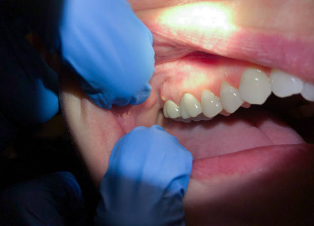 Best Emergency Root Canal Treatment in Mesquite, TX